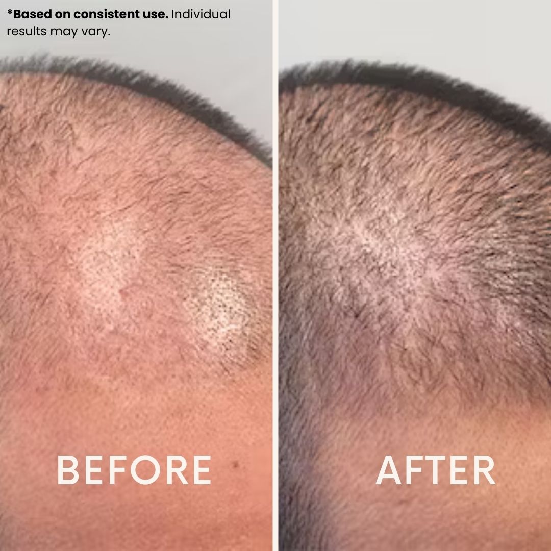 LeDoche Hair Rejuvenation System