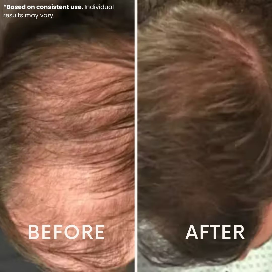 LeDoche Hair Rejuvenation System