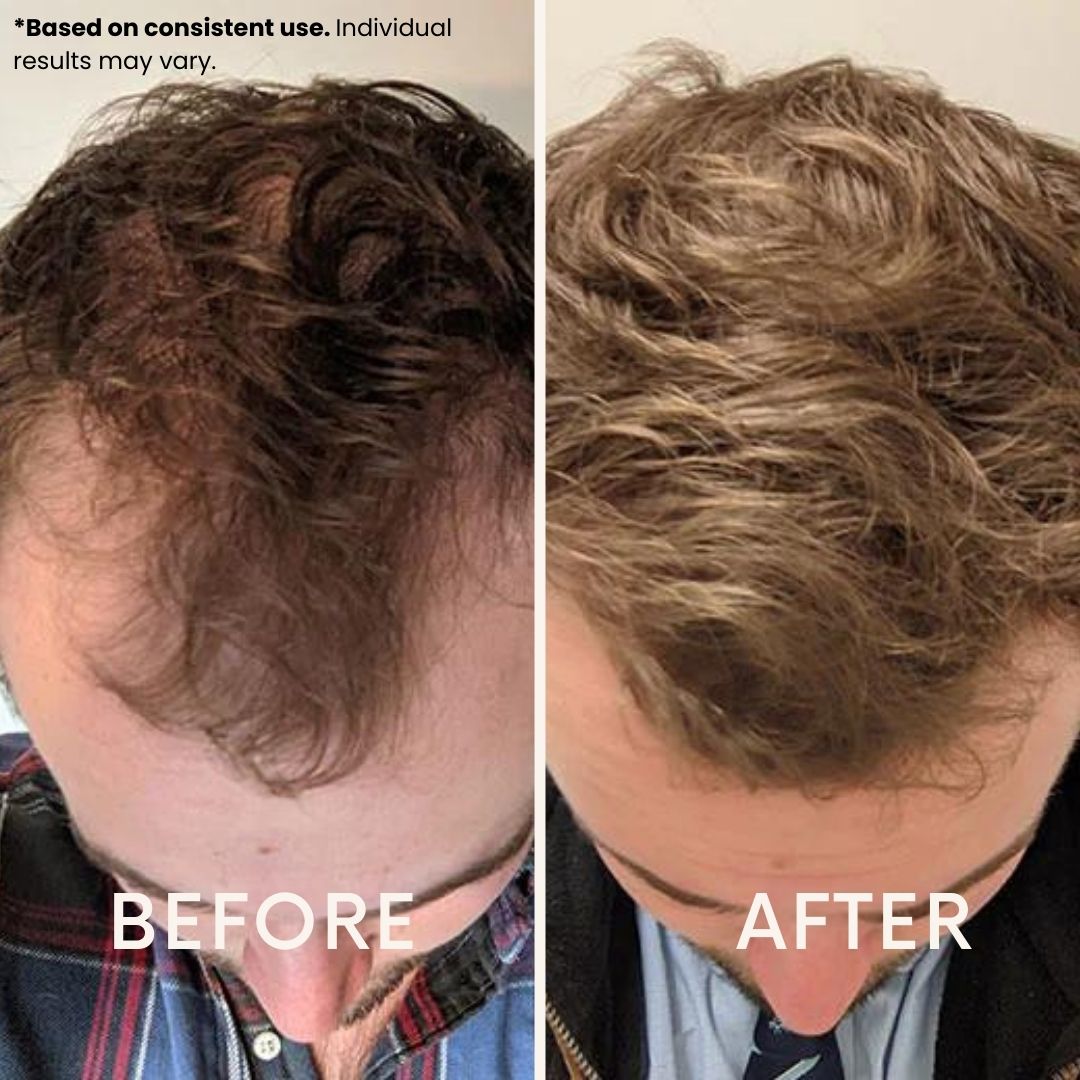 LeDoche Hair Rejuvenation System