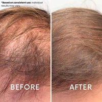Before and after using the LeDoche HairRevive Dual red light therapy hat - crown density. Based on consistent use, individual results may vary.