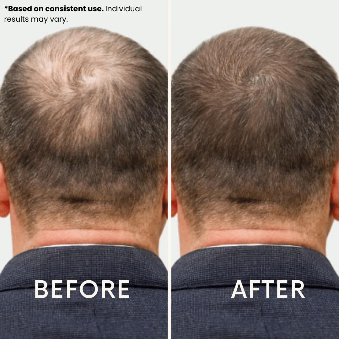 LeDoche Hair Rejuvenation System