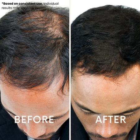 Before and after using the LeDoche HairRevive Dual red light therapy hat - hairline regrowth. Based on consistent use, individual results may vary.