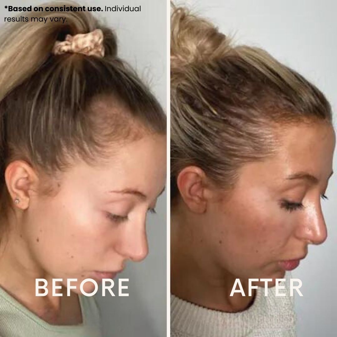 LeDoche HairRevive Dual Red Light Therapy Hat