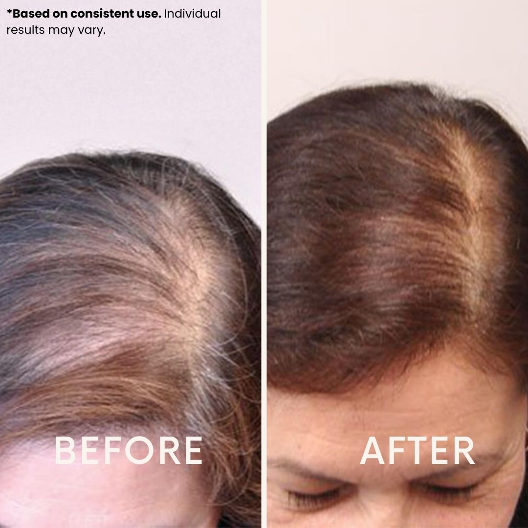 LeDoche HairRevive Dual Red Light Therapy Hat