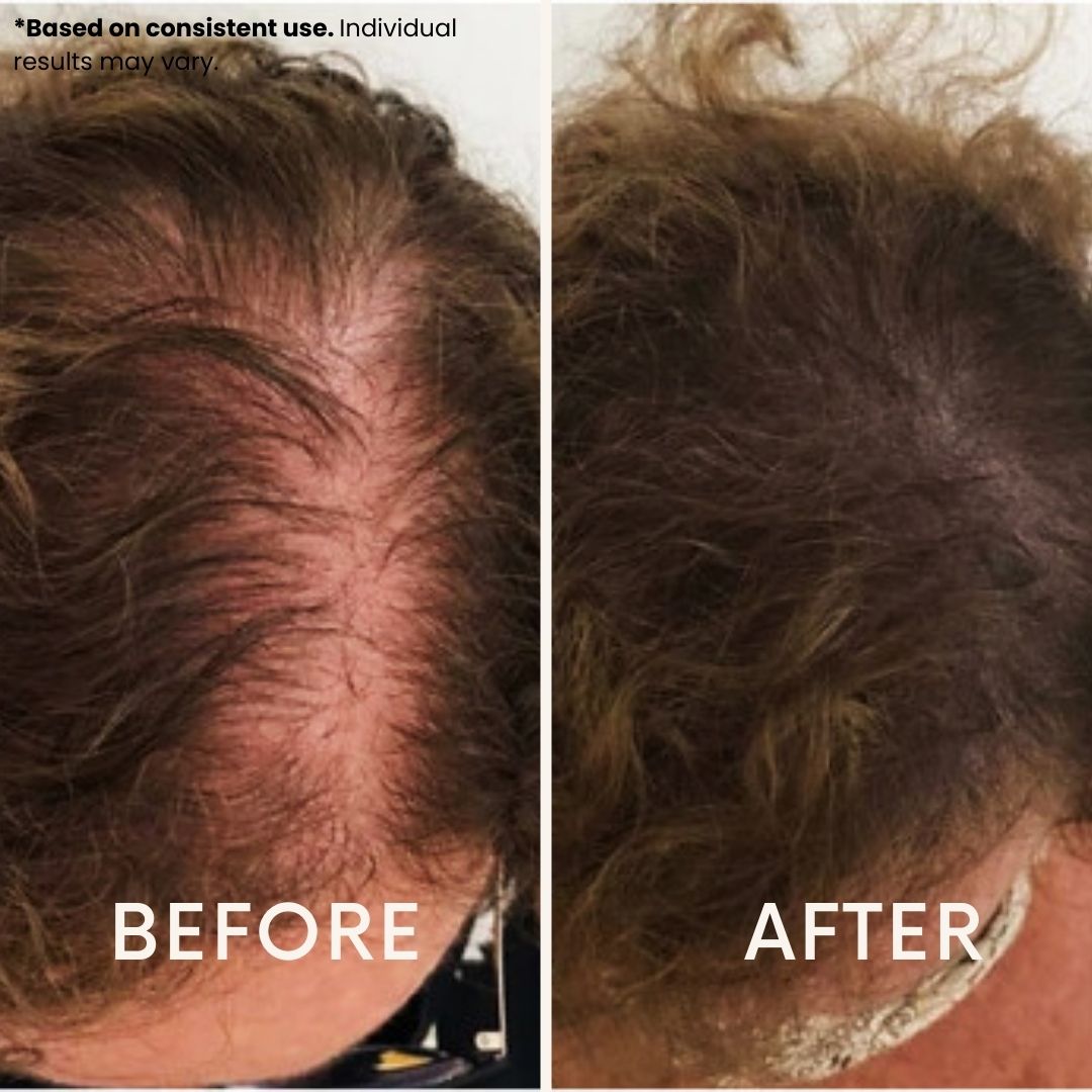 LeDoche HairRevive Dual Red Light Therapy Hat