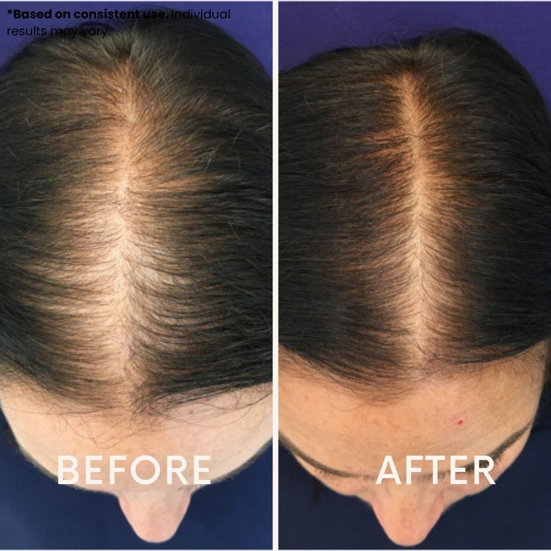 LeDoche HairRevive Dual Red Light Therapy Hat