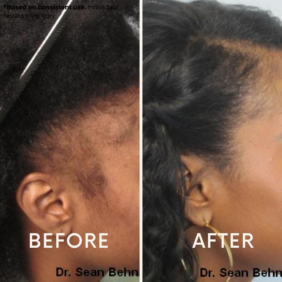 LeDoche HairRevive Dual Red Light Therapy Hat