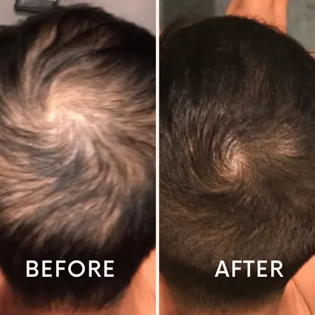 LeDoche Hair Rejuvenation System