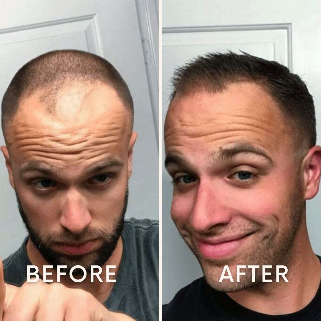 LeDoche Hair Rejuvenation System