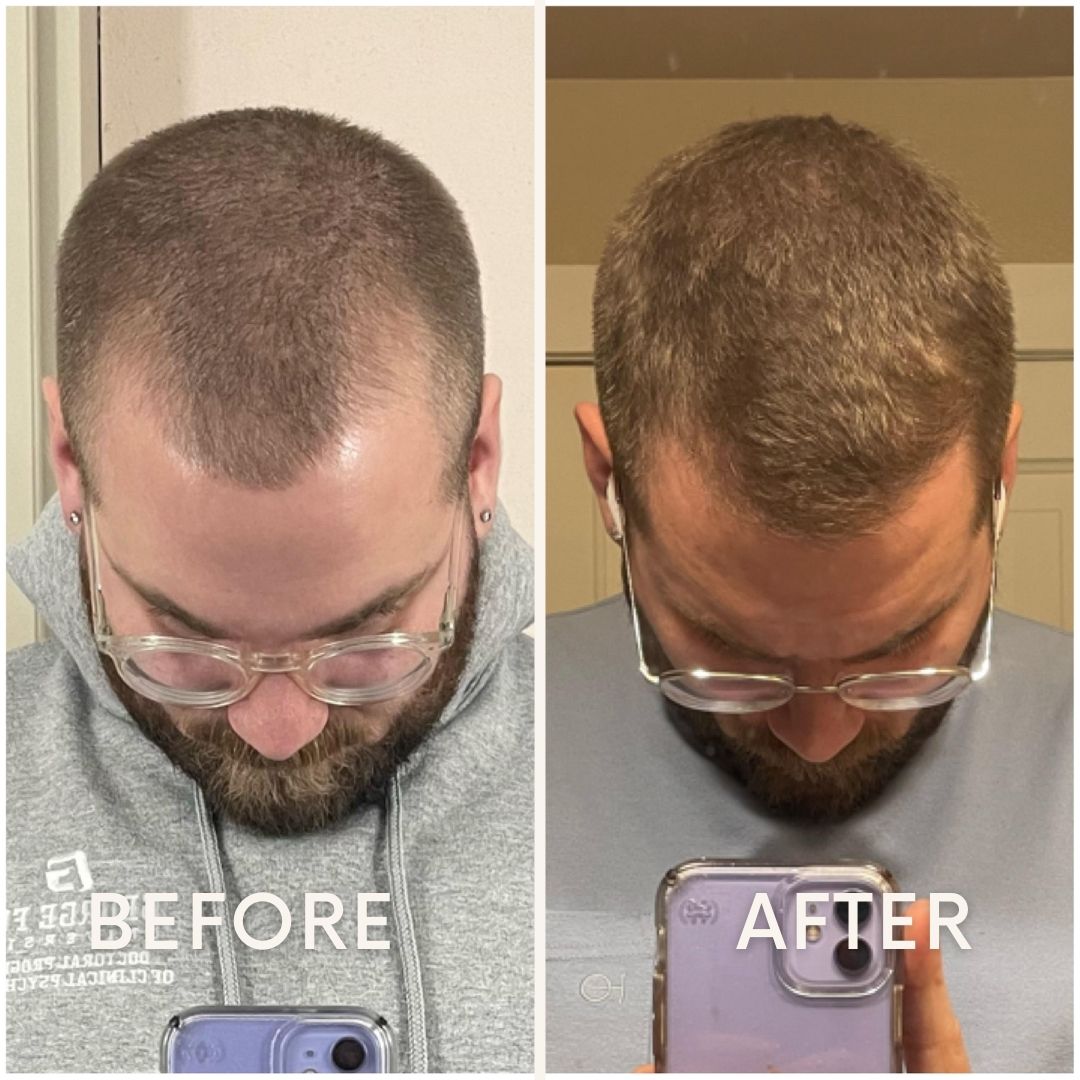 LeDoche Hair Rejuvenation System